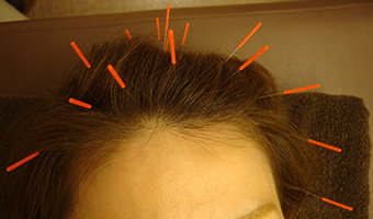 育毛鍼